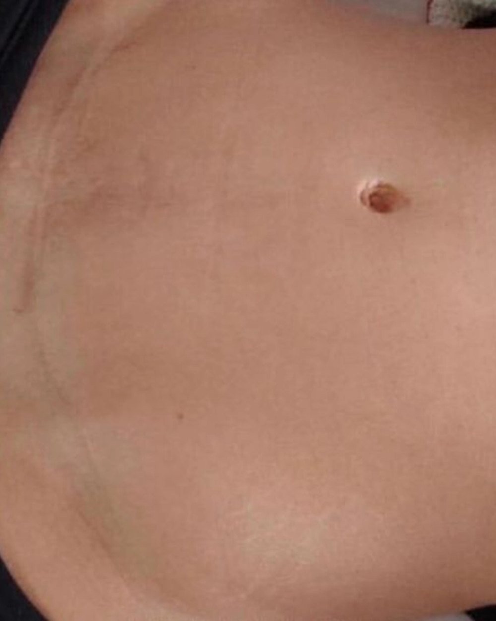 Cicatriz de abdominoplastia, depois do tratamento